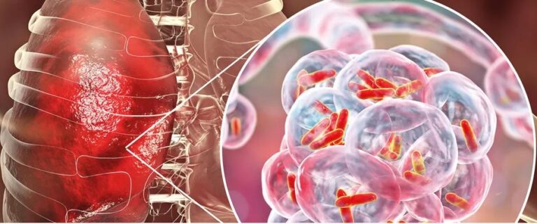 Alerta por tuberculosis en Argentina: los casos subieron un 38% y piden reforzar la vacunación